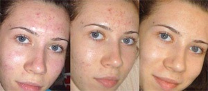 Peeling arc típusú, ellenjavallatok és értékeléseket peeling (ellenjavallatok) Peeling arc típusú, ellenjavallatok, és vélemények körülbelül peeling