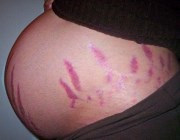 Miért terhességi csíkok vörös, fehér, kék (piros) Miért striák a bőrön vörös, fehér, kék