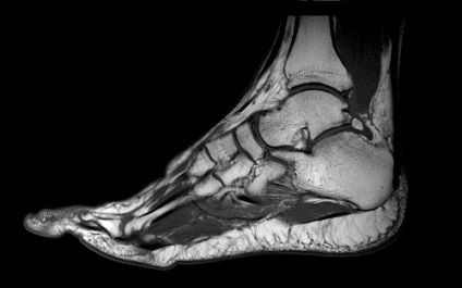 Jelzések az MRI a láb és a boka (láb) Jelzések az MRI a láb és a boka