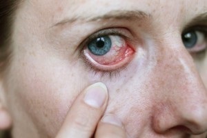 protein szemek kivörösödése okok és kezelések