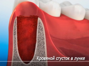 Eltávolítása után a fogat a foglalat valami fehér fotó fibrines plakk a gumikat (fehér) Eltávolítása után a fogat a foglalat valami fehér fotó fibrines plakk a fogíny
