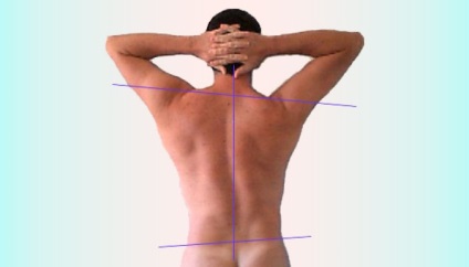 Kétoldalas scoliosis gyógytorna, edzés, masszázs (scoliosis) Kétoldalas scoliosis gyógytorna, edzés, masszázs