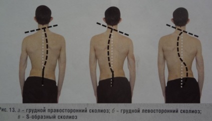 Kétoldalas scoliosis gyógytorna, edzés, masszázs (gyakorlatok) Kétoldalas scoliosis gyógytorna, edzés, masszázs