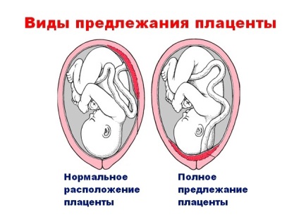 Placenta previa típusú és mértékű okoz, milyen veszélyes, diagnózis és kezelés (oka) Placenta previa típusú és mértékű okoz, milyen veszélyes, diagnózis és kezelés