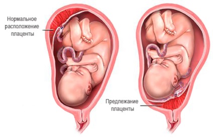 Placenta previa típusú és mértékű okoz, milyen veszélyes, diagnózis és kezelés (fok) Placenta previa típusú és mértékű okoz, milyen veszélyes, diagnózis és kezelés
