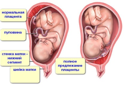 Placenta previa típusú és mértékű okoz, milyen veszélyes, diagnózis és kezelés (oka) Placenta previa típusú és mértékű okoz, milyen veszélyes, diagnózis és kezelés