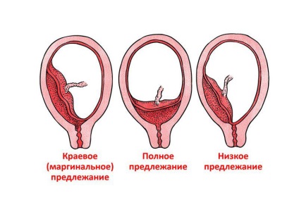 Placenta previa típusú és mértékű okoz, milyen veszélyes, diagnózis és kezelés (placenta) Placenta previa típusú és mértékű okoz, milyen veszélyes, diagnózis és kezelés