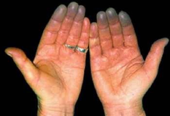 a jobb kéz kezelése szuper ízületi krém
