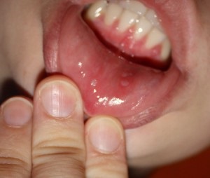A szájban lévő átlátszó hólyagok komoly aggodalomra ad okot!