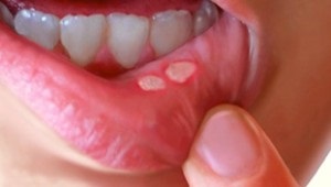 Прищик на губі (з внутрішньої сторони) причини білих пухирців у роті