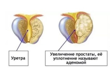 dimensiune prostata normala prosztata reakció a kezelésre