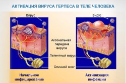 Herpesz fontos tudni, kezelés, klinikai kép (fotó és videó) (tudom) Herpesz fontos tudni, kezelés, klinikai kép (fotó és videó)