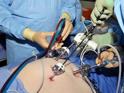 Öltés után laparoszkópia iránymutatások és jellemzői ellátás