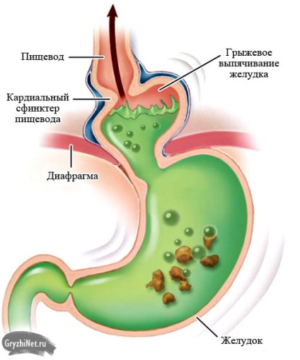 Tünetei és kezelése sérvek a gyomor