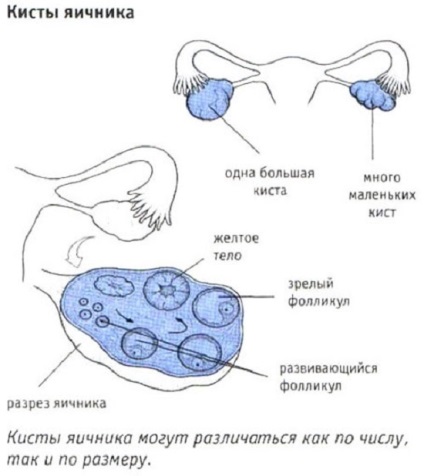 Tünetei és okai ciszták a petefészkek a nők, ahol a petefészkek, mint veszélyes (okoz) Tünetei és okai ciszták a petefészekben a nők, ha a petefészkek, mint veszélyes