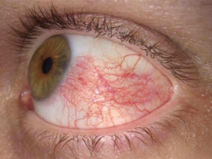 Érrendszeri betegségek a szem okok és kezelések, uflebologa