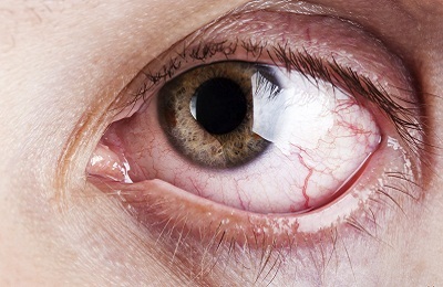 Судини в очах які бувають захворювання, симптоми і лікування
