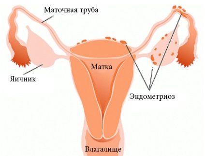 Douching vérfű endometriosis