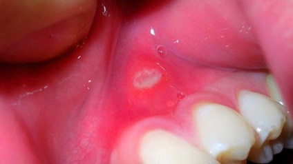Stomatitis a kezelésére szolgáló eljárások az íny és gingivitis megelőzésére (módszerek) Fekély, seb az íny módszerek kezelésére és megelőzésére gingivitis
