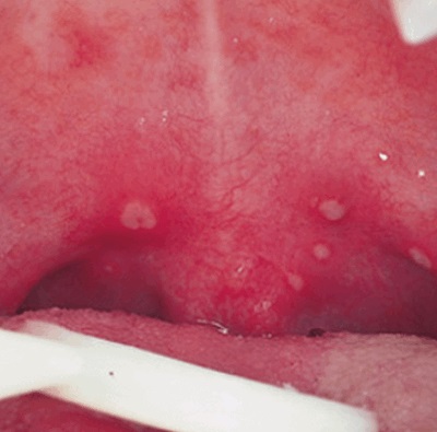 Stomatitis képen az ég, a kezelés, és a fő tünetek (a tünetek) Stomatitis képen az ég, a kezelés és a fő tünet