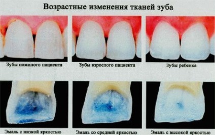 Repedések a zománc kép okoz előfordulásának és a kezelés a fogászatban