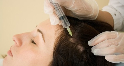 Injekciók fej hajhullás ellen és teljes kopaszság