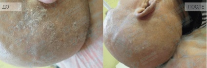 Az egyedülálló módszer a lézeres kezelés a pikkelysömör (lézer) Az egyedülálló módszer a lézeres kezelés a pikkelysömör