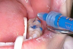 Gyermek fogápolás és szájhigiénia professzionális fogászati ​​ellátás