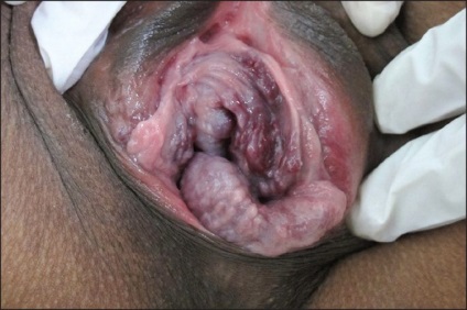 Visszértágulat vagina jellegzetes tünetek, úgy néz ki, mint a fotó, valamint a kezelés visszér