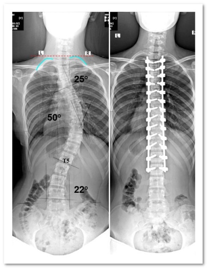 Típusai és kezelésére szolgáló eljárások scoliosis bal (ok) Formái és módszerei kezelésére gerincferdülés bal