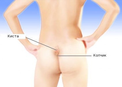 A műveletek típusai, amikor ciszta coccyx (során epiteliális farkcsonti) rezekció (eltávolítás) kezelés (kezelés) A műveletek típusai, amikor ciszta coccyx (során epiteliális farkcsonti) reszekció (eltávolítása) a kezelés