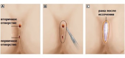 A műveletek típusai, amikor ciszta coccyx (során epiteliális farkcsonti) rezekció (eltávolítás) kezelés (kezelés) A műveletek típusai, amikor ciszta coccyx (során epiteliális farkcsonti) reszekció (eltávolítása) a kezelés