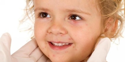 Vírusos bőrkiütés gyermekeknél a tünetek, okok, kezelés, fotók
