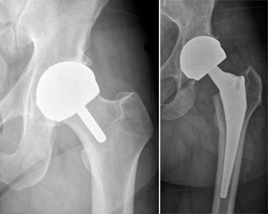 Zavar a csípő rehabilitáció, a tünetek felnőtteknél (közös) Zavar a csípő rehabilitáció, a tünetek felnőtteknél