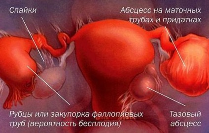 Gyulladás a függelékek okoz, a tünetek, a kezelés és a megelőzés (tünetek) Gyulladás a függelékek okoz, a tünetek, a kezelés és a megelőzés