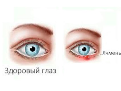 Запалення райдужної оболонки ока причини, симптоми, лікування