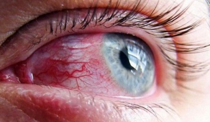 Запалення райдужної оболонки ока причини, симптоми, лікування