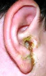 Запалення вуха симптоми, причини і лікування у дорослих і дітей