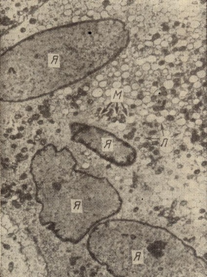 A gyulladást Mycobacterium tuberculosis által okozott (a védő szervezet működésében) - gyulladás -