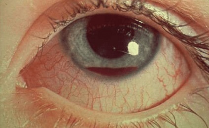 cataract kezelést népi jogorvoslat diabéteszben