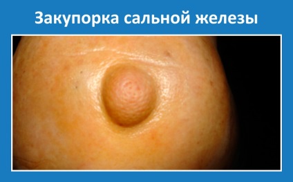 Elzáródása a faggyúmirigyek leírás képekkel (mirigy) Elzáródása a faggyúmirigyek leírás fotókkal