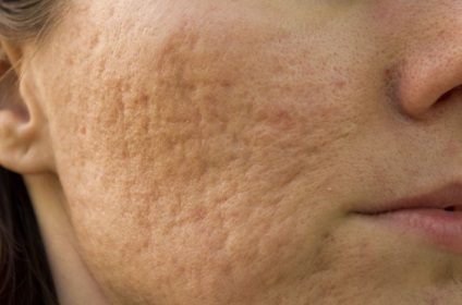 Pattanások az arcon, amit gyógyszerek és vitaminok acne vulgaris