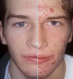 Acne vulgaris - tüneteket okoz akne a bőrön