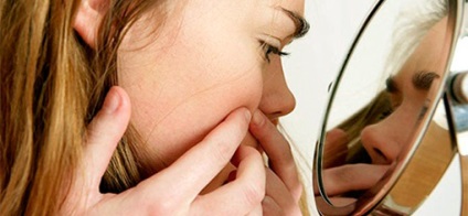 Acne vulgaris - tüneteket okoz akne a bőrön