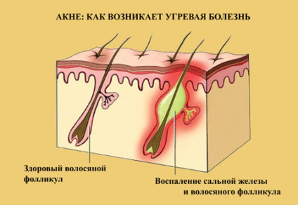 Acne vulgaris (acne vulgaris)