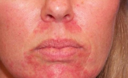 Allergiás pattanások az arcon kezelése és fotó