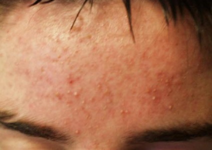 Allergiás pattanások az arcon kezelése és fotó