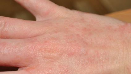 Mosószerekre allergiás fotó, okok, kezelés, abba allergia