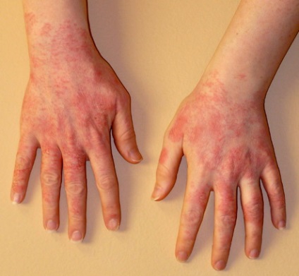 Mosószerekre allergiás a kezében, fotó allergiás reakció