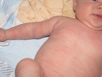 Allergia kapor víz gyermekek - tünetek, kezelés